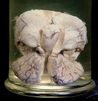Anatomia Patologica - Neoplasia cerebrale dei ventricoli