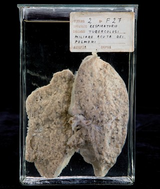 Anatomia Patologica - Tubercolosi polmonare miliare