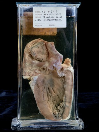 Anatomia Patologica - Aneurisma aterosclerotico dell’aorta ascendente