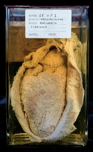 Anatomia Patologica - Pericardite fibrinosa