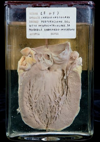 Anatomia Patologica - Endocardite ulcerosa della valvola aortica