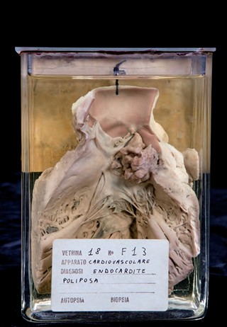 Anatomia Patologica - Endocardite ulcero-vegetante poliposa di valvola aortica bicuspide 
