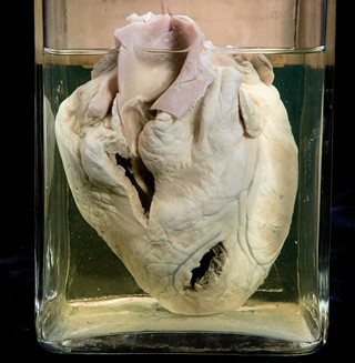 Anatomia Patologica - Infarto miocardico con rottura di cuore
