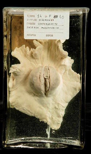 Anatomia Patologica - Linfoadenite mesenterica tubercolare