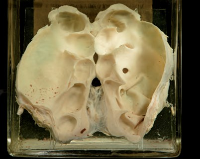 Anatomia Patologica - Idronefrosi