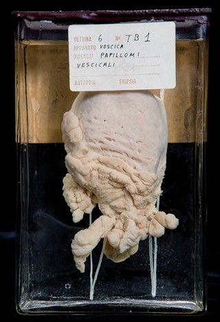 Anatomia Patologica - Neoplasie papillari della vescica